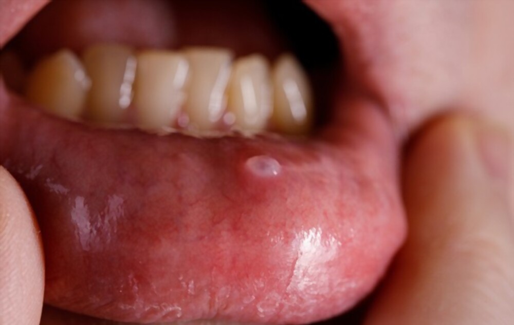 best buccal mucosa cancer bihar jharkhand bengal orissa